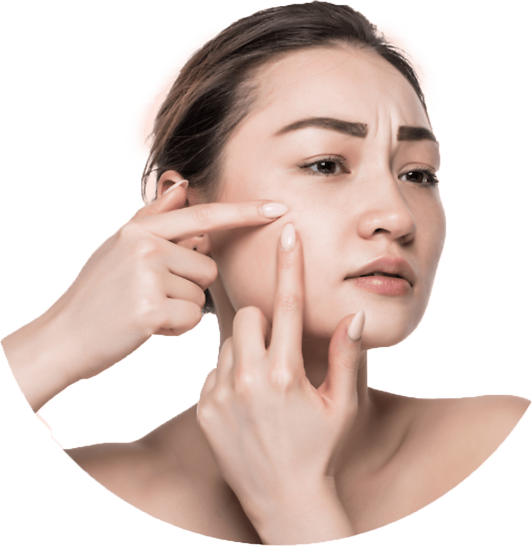 Acne Pimple Treatment Care