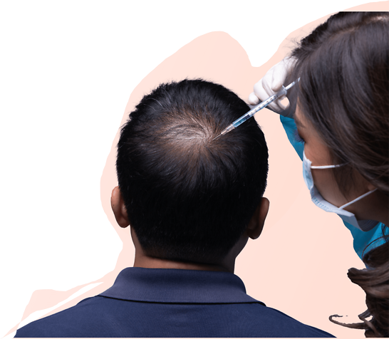 hair-transplantation-treatment